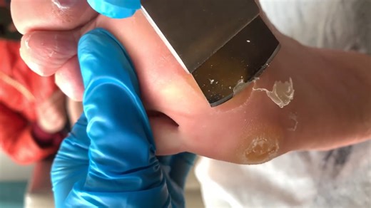 Callus removal from feet&Foot scraping dead skin【Xiao Yan pedicure】#stress 617(1) | Xiao Yan Pedicure