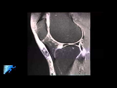 How to Read Knee MRI of Meniscal Root Tear | Knee Surgery Recovery Time | Minneapolis St Paul, MN