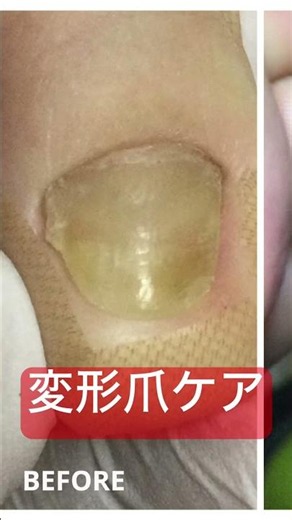 変形爪ケア 前に伸びなくなった爪
