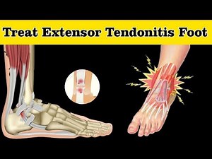 How to Treat Extensor Tendonitis Foot || Extensor Tendonitis Foot Treatment
