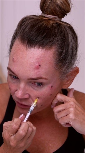 Revs Pro 32 vs Profhilo? My 2nd Treatment + Neck Threads Explained