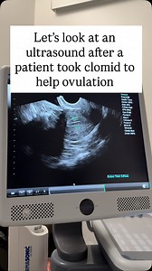 TOP POST FROM 2025: A monitoring ultrasound (in this case, after clomid) helps us confirm how the ovaries and uterine lining responded to medication and whether ovulation is occurring. On today’s scan, two mature follicles were visualized, one measuring 20mm and one 24mm, which represents an optimal response to Clomid. Follicles of this size typically indicate ovulation is imminent or already occurring (fun fact: mature follicle size is bigger on clomid than using gonadotropins). When we see thi