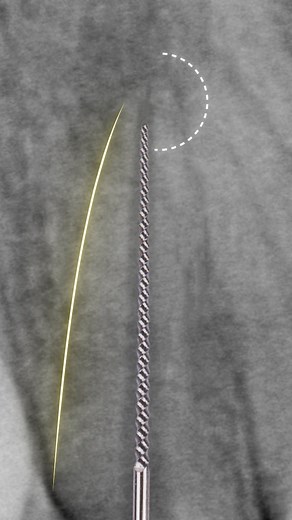 82K views · 1.1K reactions | بعد ما تعمل apical clearance يعني تنظيف...