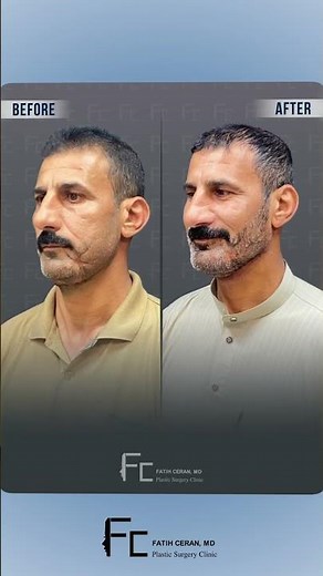 Mandibular Reconstruction with Free Fibula Flap – Beyond Expectations