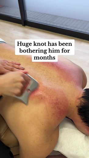 Huge Muscle Knot Release with Chiropractic Techniques