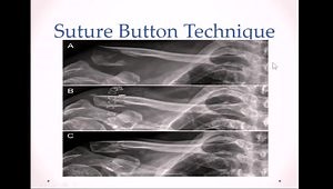 Distal Clavicle Fractures and Sternoclavicular Joint Injuries - Practical Tips and Techniques