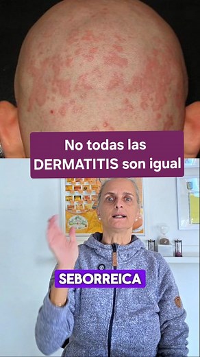 🩵 No existe una sola dermatitis. Hay muchos tipos —y entender cuál tienes es el primer paso para empezar a calmarla desde dentro 🌿 👉 Dermatitis atópica 👉 Seborreica 👉 De contacto 👉 Dishidrótica 👉 Numular 👉 Perioral 👉 Herpetiforme 👉 Fotosensible 👉 Por estasis venosa Cada una tiene su propio “idioma” en la piel: picor, descamación, ampollas o enrojecimiento… Pero todas comparten una raíz inflamatoria común. 💚 La diferencia está en lo que la provoca: alimentación, estrés, disbiosis inte