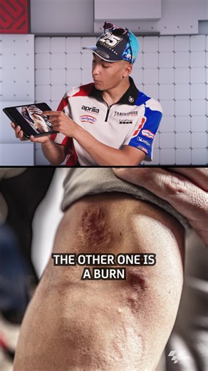 The first scar could’ve been the end for Raúl Fernández #25's career 😟⛔ Luckily he fought to rise up to the top class to tell the story 💪 #MotoGP | MotoGP