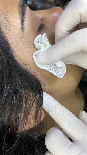 Remoção de Microdermal - Passo a Passo para a Remoção Segura