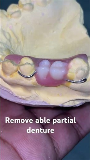 Remove able partial denture 😬😬😬#apexdental #dentistry #partialdenture #orthodontist #splittooth