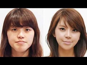 61 Korean Before and After Plastic Surgery