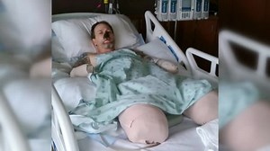 Wisconsin man has 4 limbs amputated after dog lick, survivor with same infection brings comfort