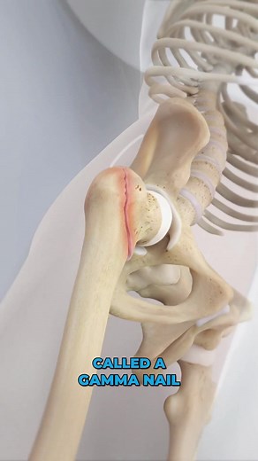 Viz Medical on Instagram: "Gamma nail femur fracture fixation repairs a broken femur by realigning the bones and using fixation to keep them in place while they heal. #femurfracturefixation #gammanail #brokenfemur #fracturefixation #medicaleducation #medicalanimation #3danimation #3dmedicaleducation #3danimationsurgery"