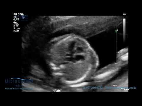 Baby Heart Motion At 12 Weeks II Ultrasound Ireland