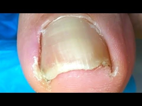 The Toenail Has Two Protruding Nails! Deal With【Crazy pedicure room】