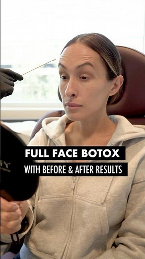 Full Face Botox with Before and After Results at the End 🧖‍♀️ #botox #before andafter re