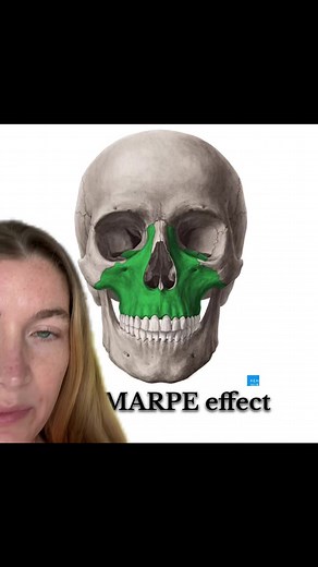 #duet with @𝐚𝐯𝐚𝐳𝐨𝐮𝐬 #maxilla really awesome animation demonstrating what MARPE can do.