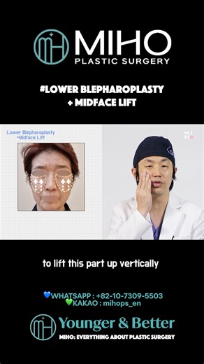 Midface lift + Lower Blepharoplasty @mihoplasticsurgerykorea4827