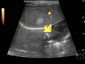 USG wątroby naczyniak Liver Ultrasound Angioma child DIAGNOSON Gdańsk