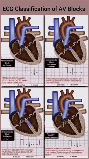 Abdallah Othman on Instagram: "📈Classification of AV Blocks: Save this guide 📌 | Share with your network! #Cardiology #ECG #HeartHealth #MedEd #AVBlocks #MedicalVisuals"