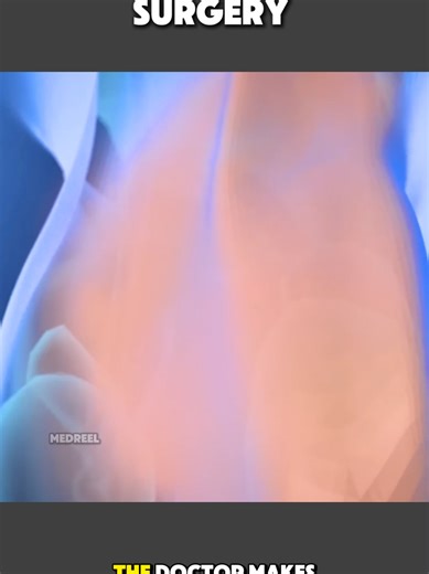 Understanding Vasectomy Surgery Through 3D Animation