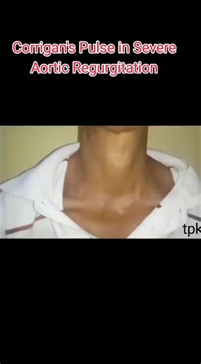 Understanding Corrigan's Pulse and Water Hammer Pulse