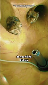 Percutaneous nephrolithotomy (PCNL) (3D Animation)
