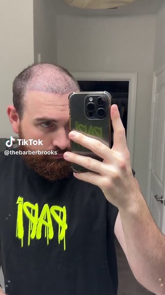 @HairNeva gives the best Christmas presents 🎁#hairtransplant #hairtransplantturkey #fyp #barber