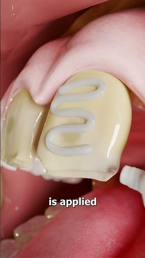 How Veneers Work 😮