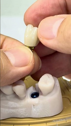 Process for molar implants!