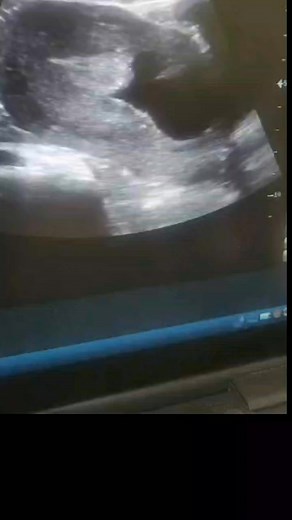 Serum pt positive Bleeding PV your opinion on this | Sonographer Ultrasound