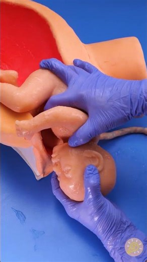 Sichere Geburtssimulation: Umgang mit einer Nabelschnurumschlingung während der Geburt 🩺🤱