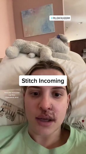 #stitch with @marguerite.josephine Filler complication and vascular occlusion: what to avoid! #dermatologist #skintok #lipfiller #vascularocclusion #fillergonewrong #pillowtalkderm @shereeneidriss