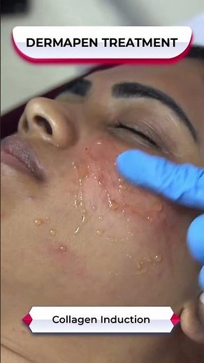 Achieve Radiant Skin with Microneedling using Dermapen ‪@sakhiyaskinclinic‬