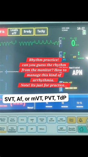 Guess the rhythm ❗️management? #ECG #ekg #cardiology #medstudent #medicine #cardiologia #medicina #thestubborndr #medical #paramedic #Cardiology #medizin #internalmedicine #Mi #nursing #medecine #emt | The Stubborn Dr