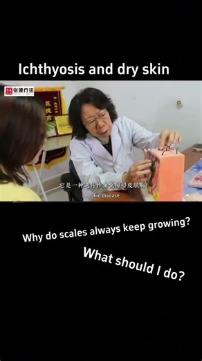 Ichthyosis and dry skin, why do scales always keep growing?#ichthyosistreatment#ichthyosisvulgaris