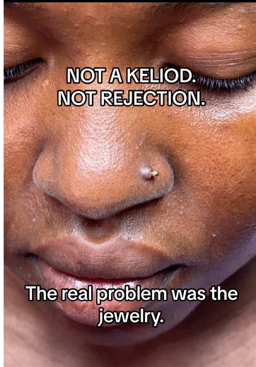 She thought she was losing her nose piercing. The bump was getting worse, jewelry felt tight and the pain was becoming difficult to ignore. After assessment, the problem wasn’t what she thought. The jewelry was too short for her anatomy, creating constant pressure on the piercing. Not every bump is a keloid. Not every irritated piercing is rejecting. Sometimes the issue is the jewelry itself. If your nose piercing feels tight, keeps developing bumps or looks like it’s sinking into your skin, don