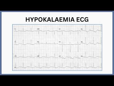 Hypokalaemia ECG Changes Explained