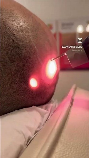 SMP Removal at Zapp Laser Studio #smp #scalpmicropigmentation #laser