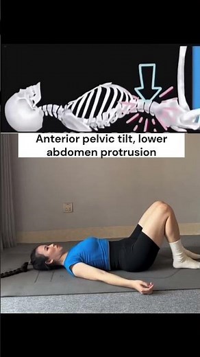 Anterior Pelvic Tilt Explained: Why Your Lower Belly Sticks Out (And How to Fix It)