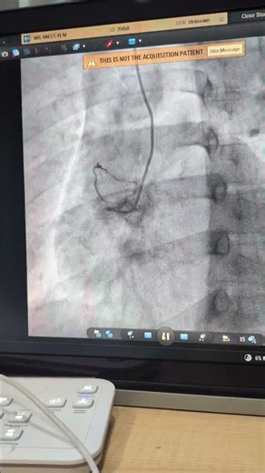 Coronary Angiography | RCA 100% Chronic Total Occlusion (CTO) | Complete RCA Blockage |Cath Lab Case