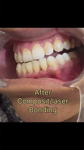 Composit restoration for marginal cavities #dentalcare #dentist #drsaba #oralhealth #dentalphilosphy