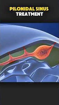 Pilonidal Sinus Laser Surgery | Minimal Cyst Removal (3D Animation