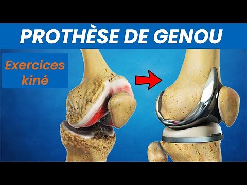 Knee replacement: Physiotherapy rehabilitation exercises