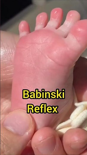 Babinski Reflex