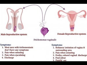 Diagnosis methods for Trichomoniasis; combination of clinical evaluation, laboratory tests