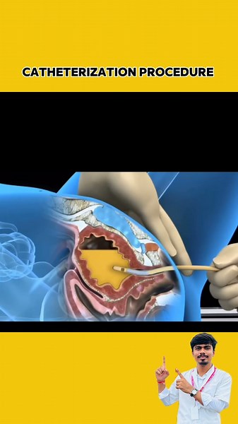 Catheterization procedure #shorts #rohitnursetalks