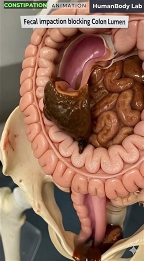 Inside a Constipated Colon You Won’t Believe This | Gut Health
