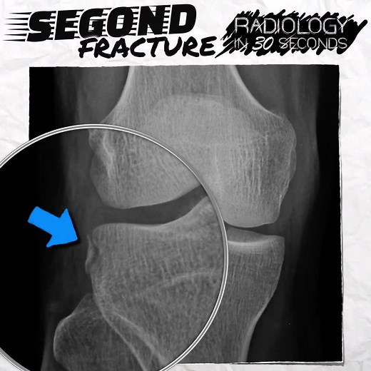 69K views · 1.2K reactions | Just one of several tiny but important fractures around the knee. All will feature in our upcoming Emergency Radiology Course. Register here: www.radiopaedia.org/courses | Radiopaedia.org | Facebook