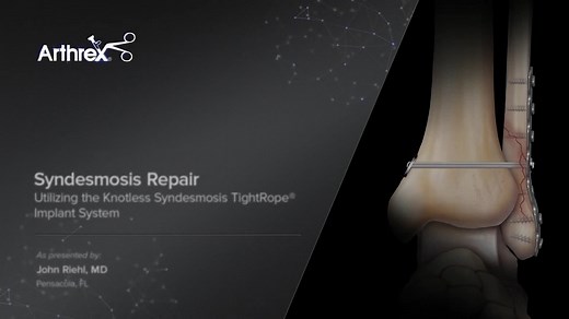 Syndesmosis Repair Utilizing the Knotless Syndesmosis TightRope® Implant System